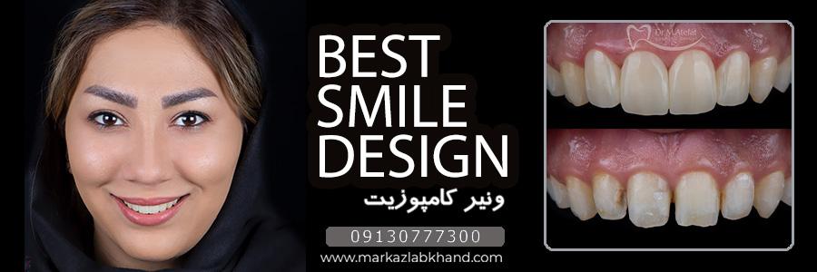 اصلاح طرح لبخند با ونیر کامپوزیت در اصفهان توسط دکتر محمد عاطفت