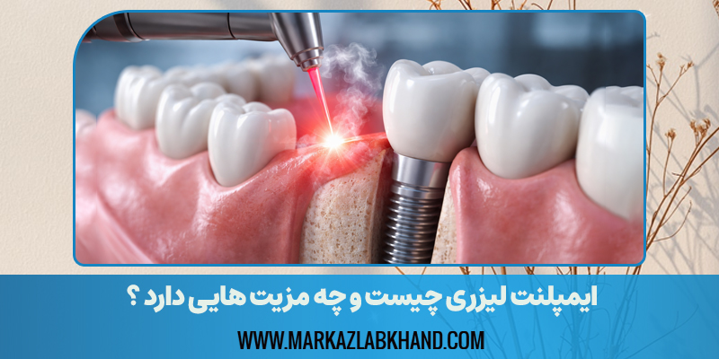 ایمپلنت لیزری در اصفهان