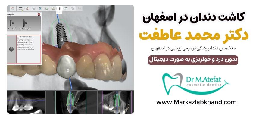 کاشت دندان به روش دیجیتال در اصفهان | دکتر محمد عاطفت متخصص ایمپلنت و دندانپزشکی زیبایی و ترمیمی در اصفهان
