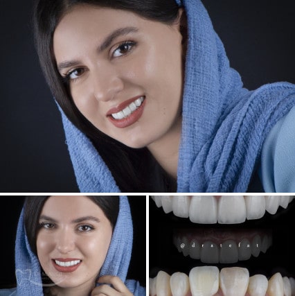 ونیر کامپوزیت در اصفهان | دکتر محمد عاطفت متخصص دندانپزشکی زیبایی