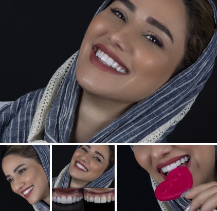 ونیر کامپوزیت در اصفهان | دکتر محمد عاطفت متخصص دندانپزشکی زیبایی