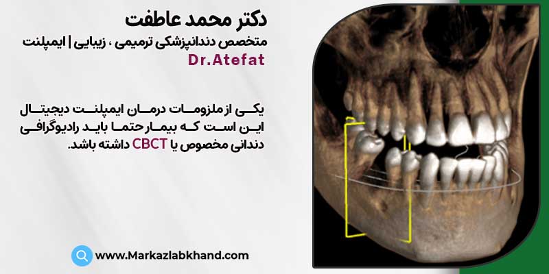 ملزومات درمان ایمپلنت دیجیتال دندان