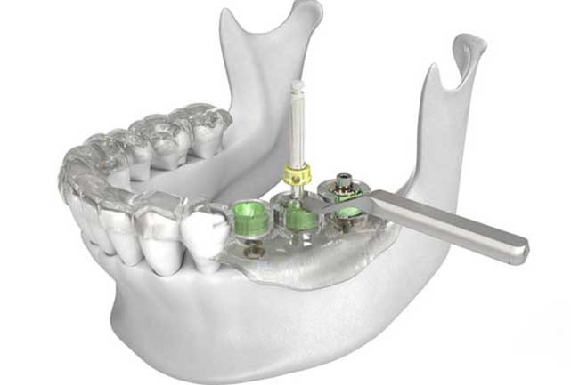 ایمپلنت دندان بدون جراحی
