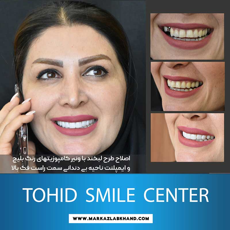اصلاح طرح لبخند با ونیر کامپوزیت توسط دکتر محمد عاطفت متخصص دندانپزشکی زیبایی در اصفهان