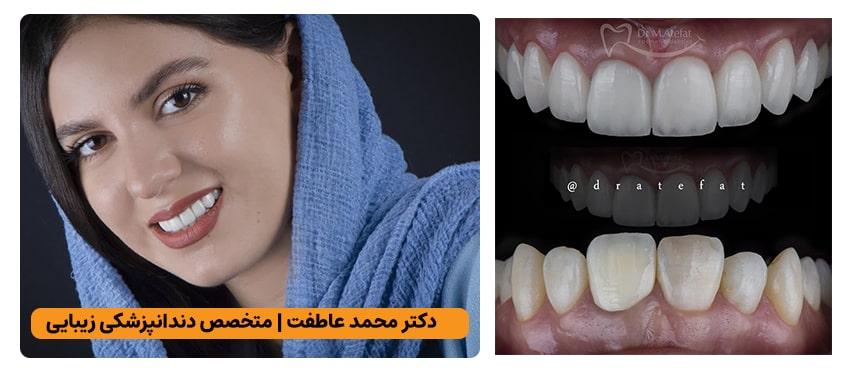 نمونه کار دندانپزشکی زیبایی در اصفهان