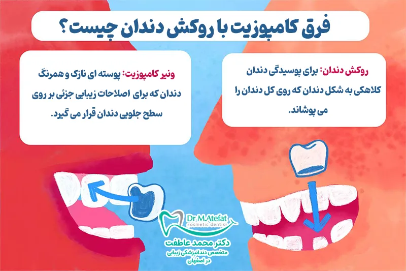فرق کامپوزیت با روکش