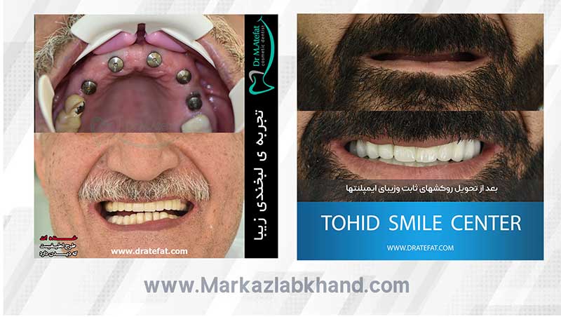ایمپلنت دندان در اصفهان در مرکز دندانپزشکی دکتر محمد عاطفت