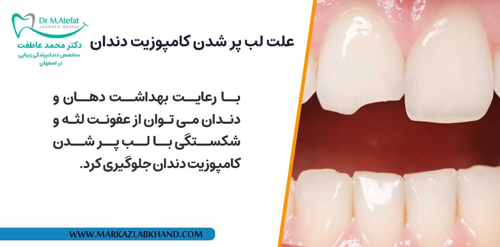علت لب پر شدن کامپوزیت دندان