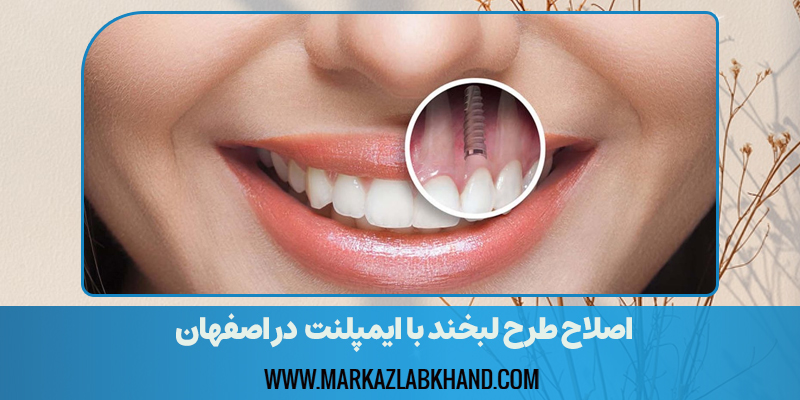 اصلاح طرح لبخند با ایمپلنت در اصفهان