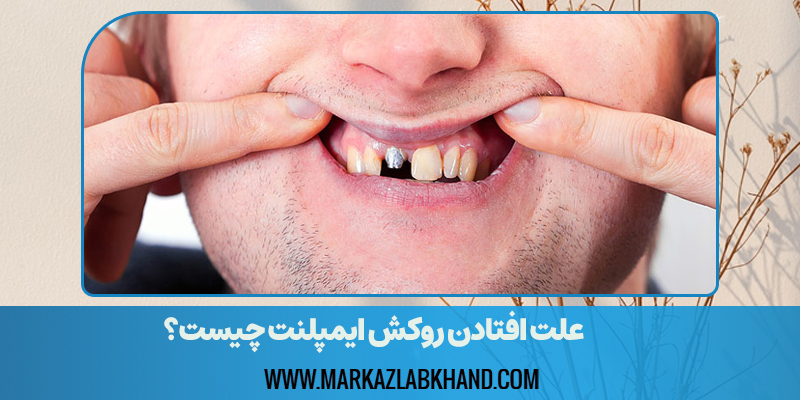 افتادن روکش ایمپلنت دندان