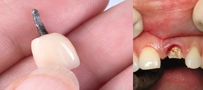 افتادن روکش ایمپلنت دندان