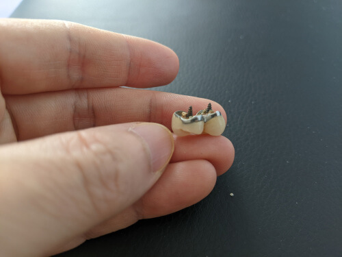 افتادن روکش ایمپلنت دندان