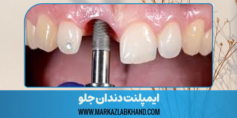 ایمپلنت دندان جلو