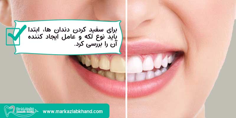 انواع لکه های دندان بر اساس عامل ایجاد کننده آنها