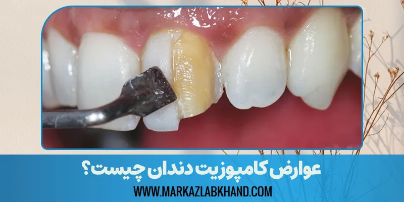 عوارض و معایب ونیر کامپوزیت