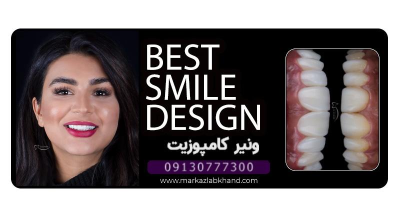 سفید کردن کامپوزیت دندان در اصفهان توسط دکتر محمد عاطفت