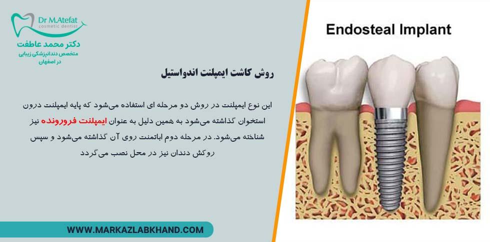 روش کاشت ایمپلنت اندواستیل از انواع روش های کاشت ایمپلنت دندان در اصفهان