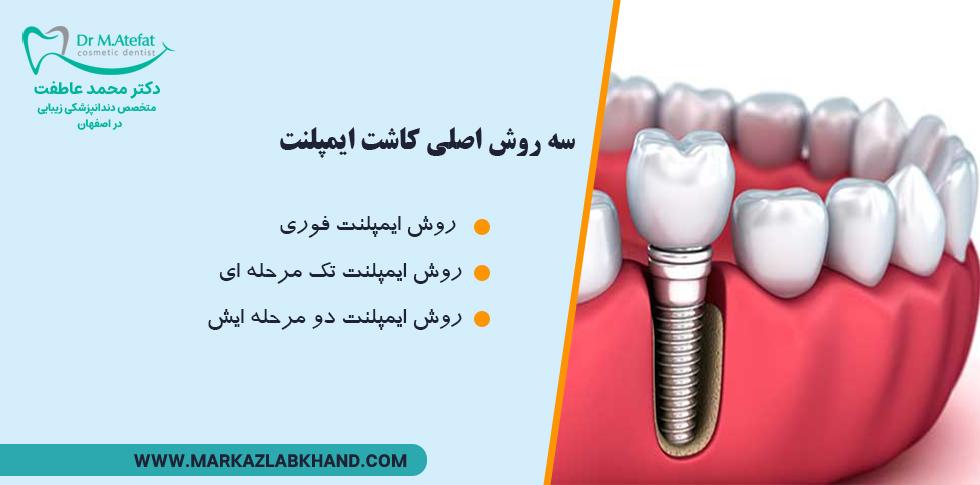 انواع روش های کاشت ایمپلنت دندان در اصفهان