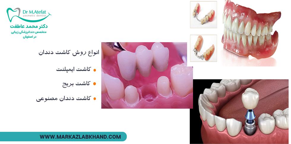 انواع روش های کاشت دندان در اصفهان