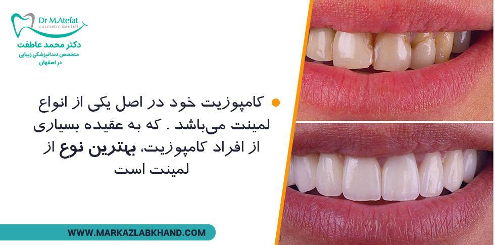 انواع کامپوزیت دندان در اصفهان