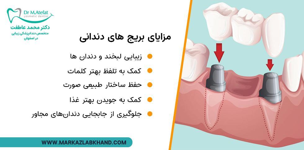 مزایای بریج دندان در اصفهان