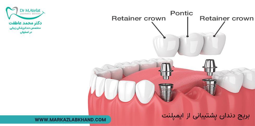 پل دندانی با پشتیبانی از ایمپلنت از انواع روش های بریج دندان