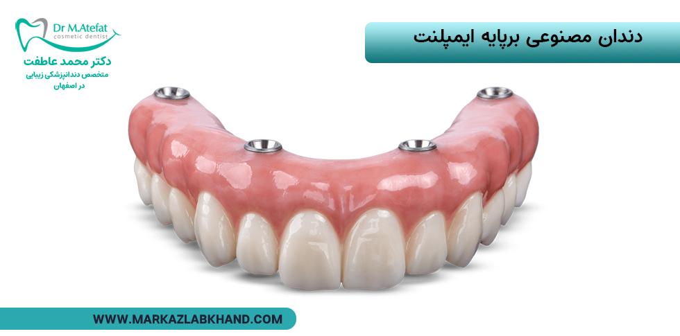 دندان مصنوعی برپایه ایمپلنت