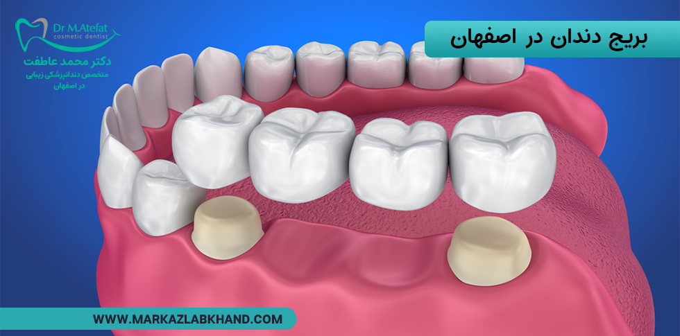 بریج دندان در اصفهان