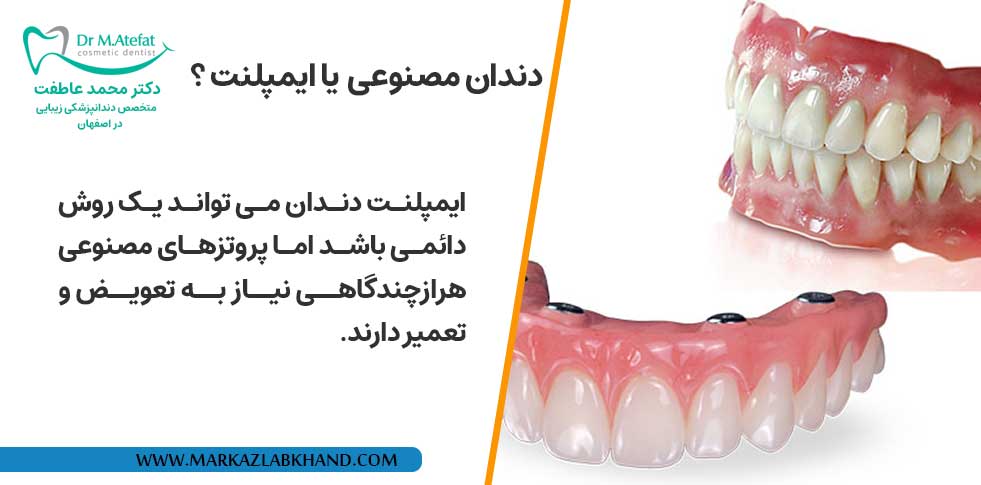 دندان مصنوعی بهتر است یا ایمپلنت دندان؟