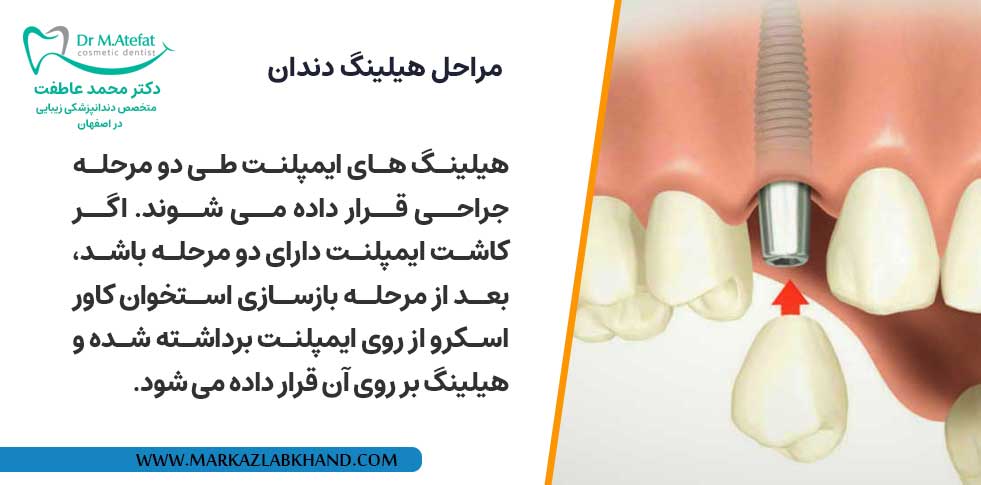 مراحل هیلینگ دندان