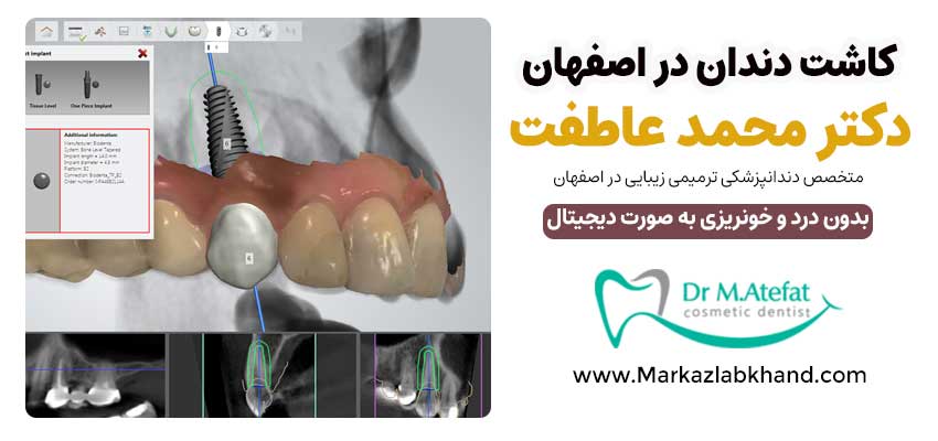 کاشت دندان در اصفهان