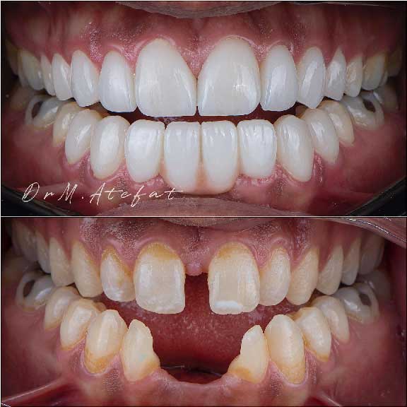 نمونه درمان دیاستم در اصفهان توسط دکتر محمد عاطفت