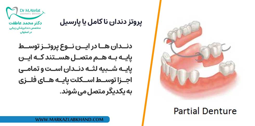 پروتز دندان نا کامل یا پارسیل (پارشیل)