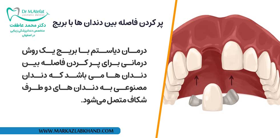 درمان دیاستم
