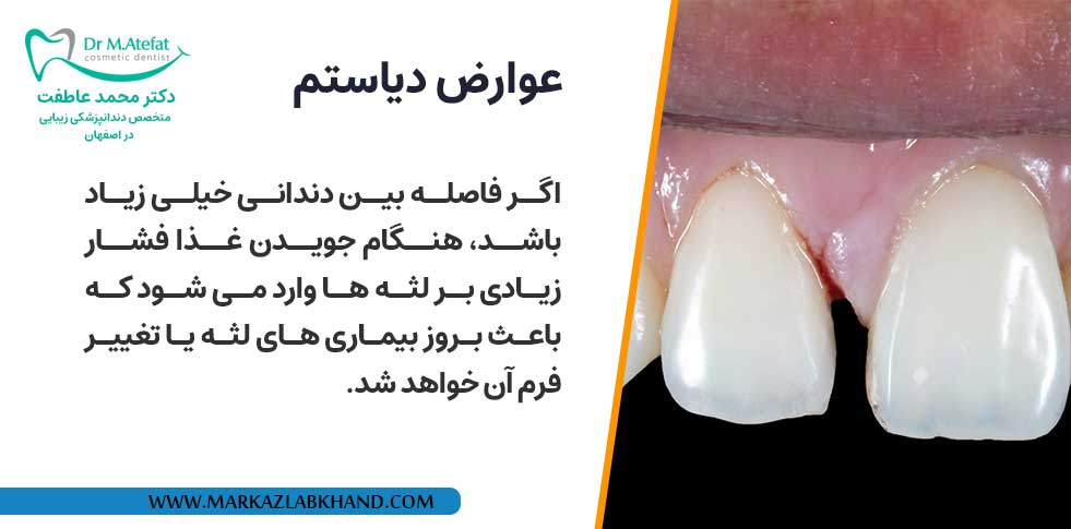 عوارض دیاستم چیست؟