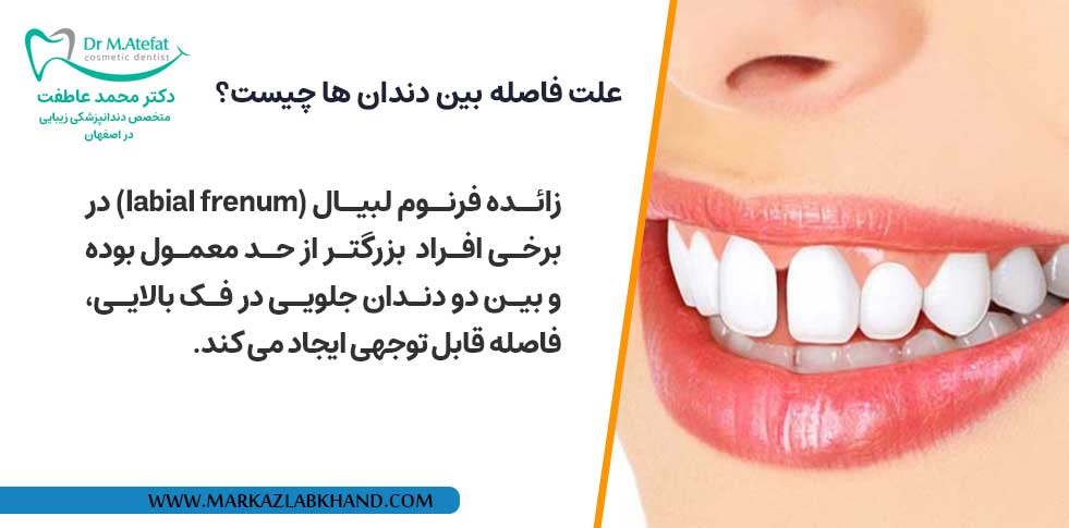 علت فاصله بین دندان ها چیست؟