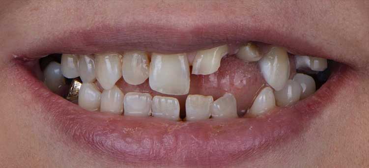 قبل از دندانپزشکی زیبایی