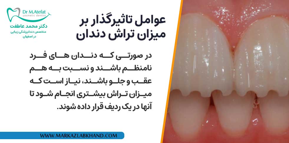 عوامل تاثیرگذار بر میزان تراش دندان