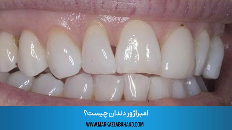 فضای خالی و سیاه بین دندان ها، درمان امبراژور دندان