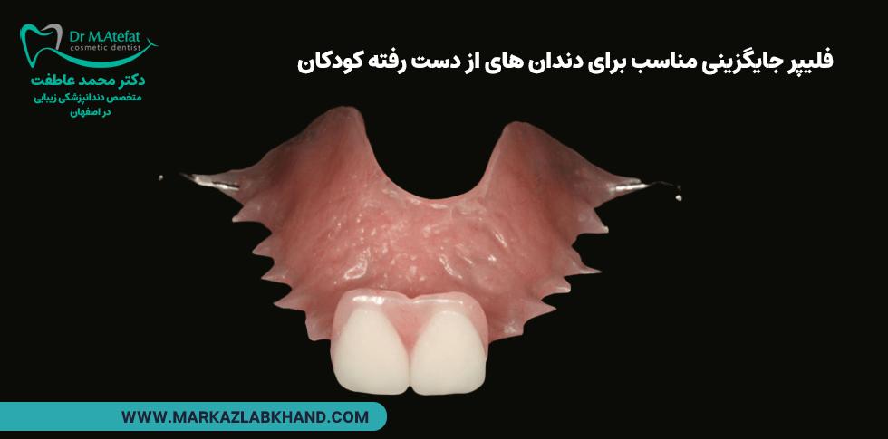 فلپیر روشی مناسب برای جایگزینی دندان های از دست رفته