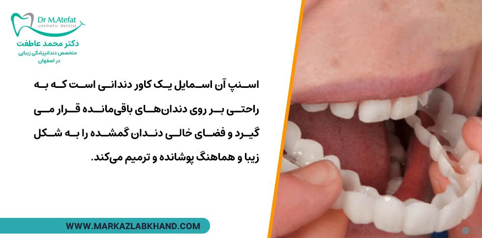 کاور دندان(اسنپ آن اسمایل) جایگزین مناسب ایمپلنت برای کودکان