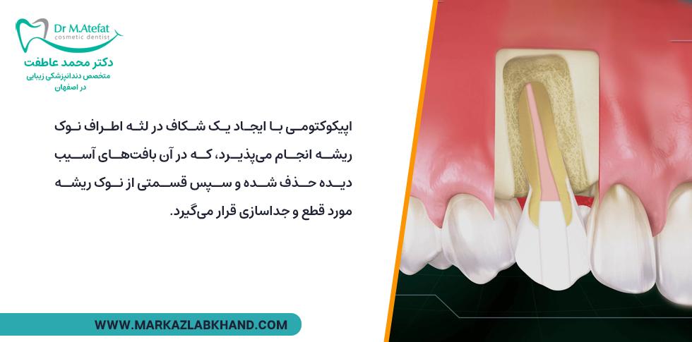 نحوه انجام جراحی ریشه دندان (اپیکوتومی)