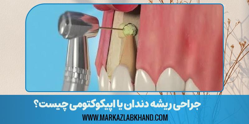 جراحی ریشه دندان (اپیکوکتومی) چیست؟