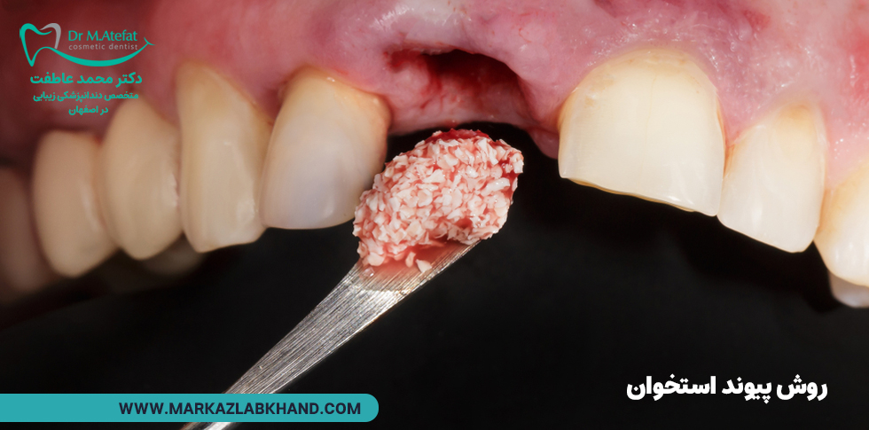 روش پیوند استخوان در ایمپلنت دندان