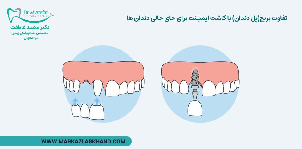 تفاوت بریج با ایمپلنت برای جای خالی دندان ها