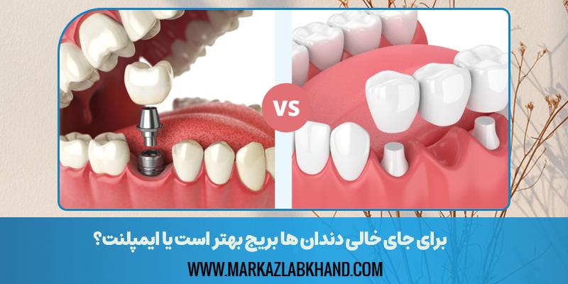 برای جای خالی دندان ها بریج بهتر است یا ایمپلنت؟