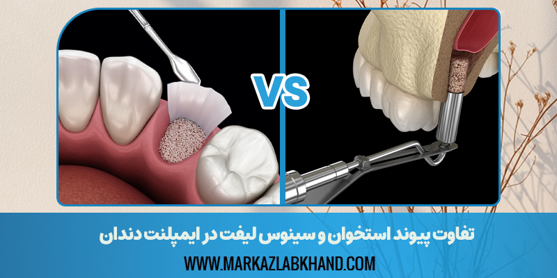 تفاوت پیوند استخوان و سینوس لیفت در ایمپلنت دندان