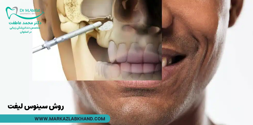 روش سینوس لیفت در ایمپلنت دندان