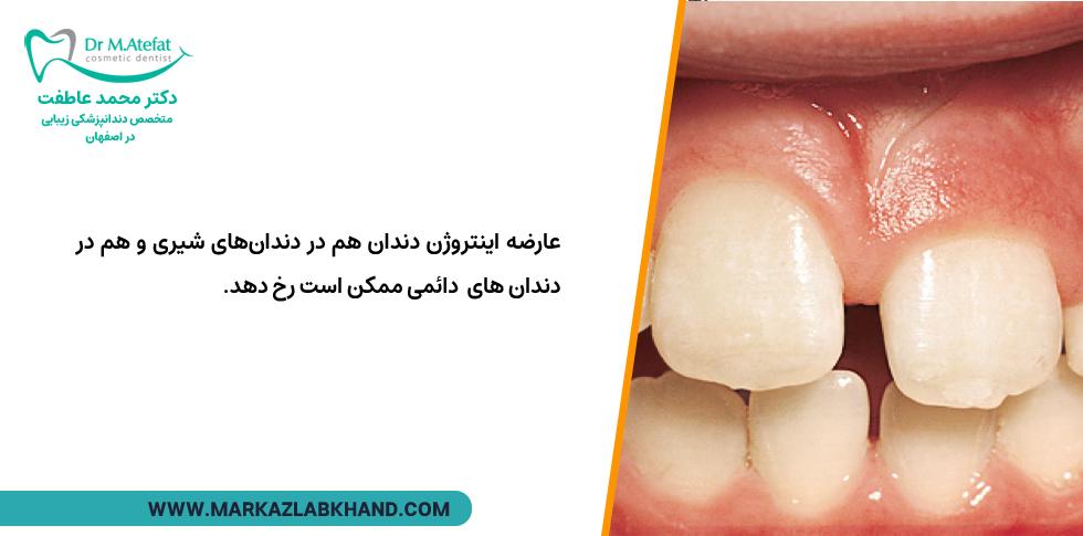 عارضه اینتروژن دندان هم در دندان‌های شیری و هم در دندان های دائمی ممکن است رخ دهد.
