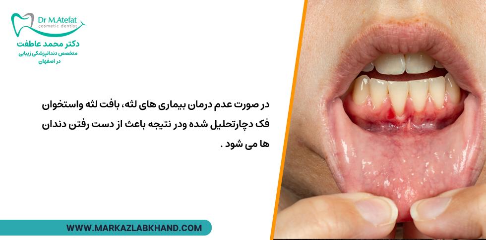 بیماری پریودنتال لثه و تحلیل لثه